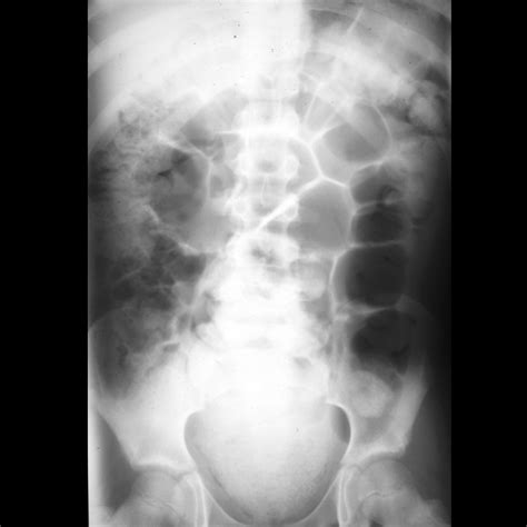 randy's severely constipated|Randy's Severely Constipated .